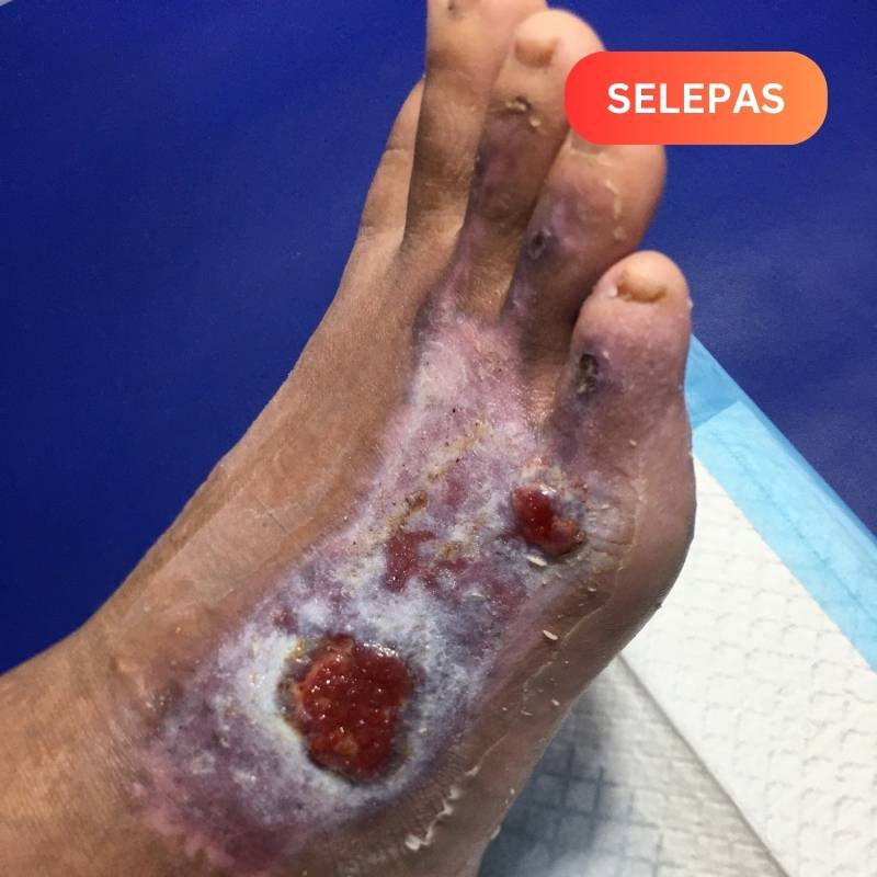 Dressing dan cuci luka - U.N.I Klinik Alor Gajah 2